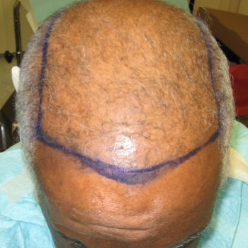 before Hair Transplant & AFR