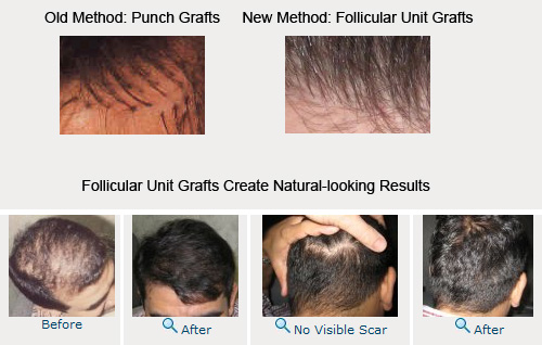 Follicular Unit Grafts are Superior to Older Punch Grafts for Hair Transplants