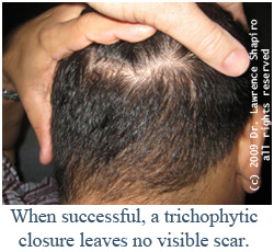 When successful, a trichophytic closure leaves no visible scar.